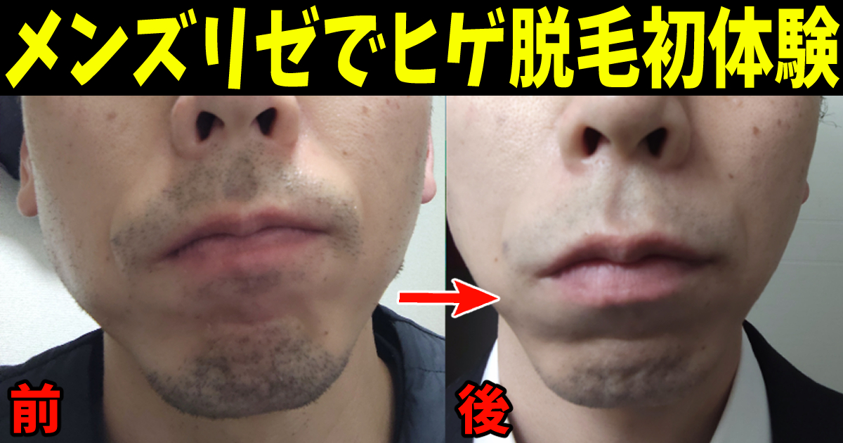 「メンズリゼ」のヒゲ脱毛でヤグレーザーを経験
