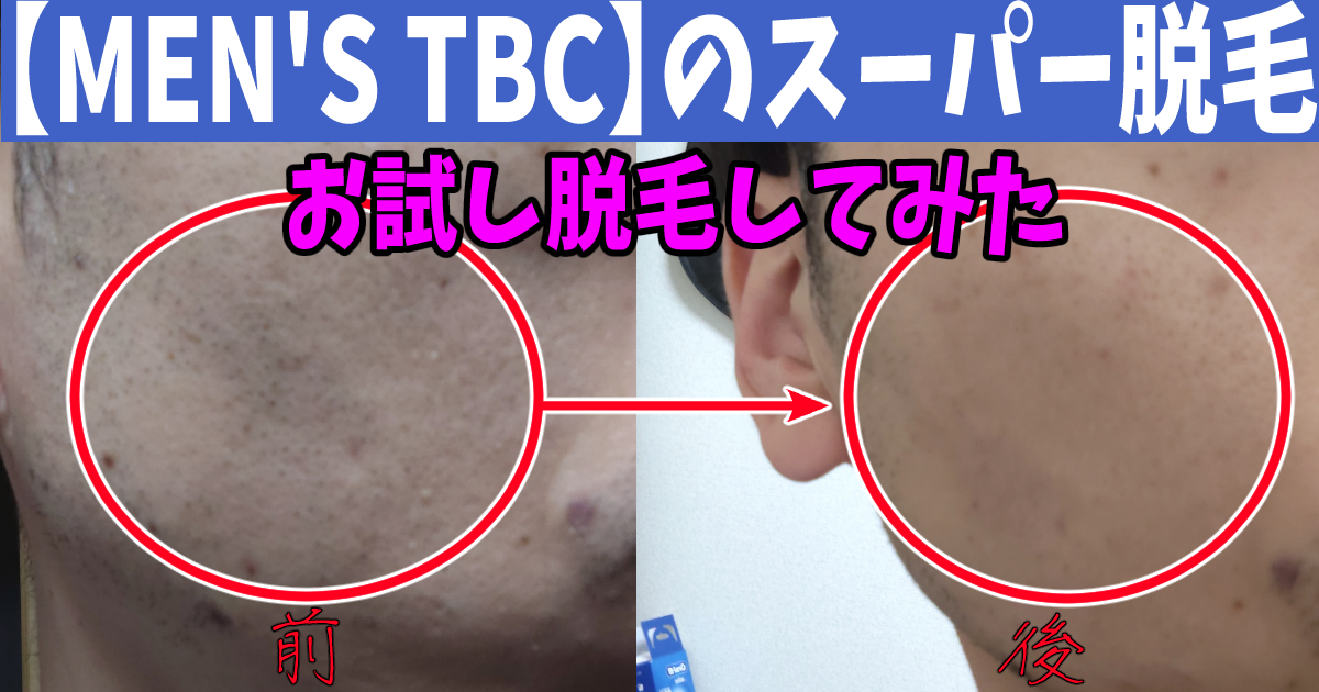 【MEN'S TBC】のスーパー脱毛