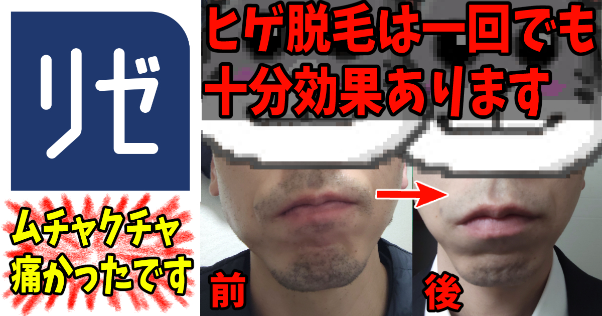 「メンズリゼ」のヒゲ脱毛でヤグレーザーを経験